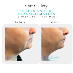 Fillers & PRF | Before & After | Elanté Rejuvenation | Medical Grade Aesthetics Clinic | SW Calgary