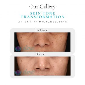 Skin Tone | Before & After | Elanté Rejuvenation | Medical Grade Aesthetics Clinic | SW Calgary