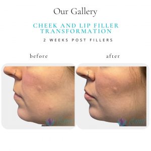 Cheek & Lip Filler | Before & After | Elanté Rejuvenation | Medical Grade Aesthetics Clinic | SW Calgary