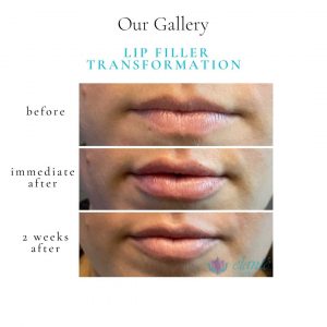 Lip Filler | Before & After | Elanté Rejuvenation | Medical Grade Aesthetics Clinic | SW Calgary