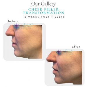 Cheek Filler | Before & After | Elanté Rejuvenation | Medical Grade Aesthetics Clinic | SW Calgary