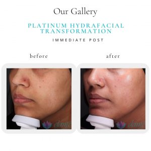 Platinum HydraFacial | Before & After | Elanté Rejuvenation | Medical Grade Aesthetics Clinic | SW Calgary