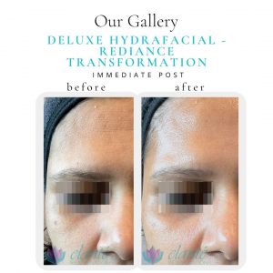 Deluxe HydraFacial Before & After | Before & After | Elanté Rejuvenation | Medical Grade Aesthetics Clinic | SW Calgary