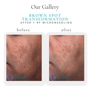 RF Microneedling Before & After | Before & After | Elanté Rejuvenation | Medical Grade Aesthetics Clinic | SW Calgary