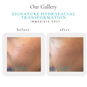 Signature HydraFacial Before & After | Before & After | Elanté Rejuvenation | Medical Grade Aesthetics Clinic | SW Calgary