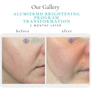 Alumier MD Lightening Before & After | Before & After | Elanté Rejuvenation | Medical Grade Aesthetics Clinic | SW Calgary