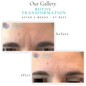 Botox® Before & After | Before & After | Elanté Rejuvenation | Medical Grade Aesthetics Clinic | SW Calgary