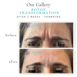 Botox® Before & After | Before & After | Elanté Rejuvenation | Medical Grade Aesthetics Clinic | SW Calgary