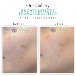 Laser Session Before & After | Before & After | Elanté Rejuvenation | Medical Grade Aesthetics Clinic | SW Calgary