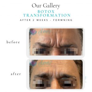 Botox® Before & After | Before & After | Elanté Rejuvenation | Medical Grade Aesthetics Clinic | SW Calgary