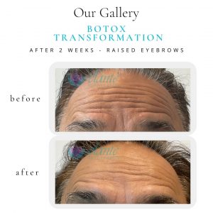 Botox® Before & After | Before & After | Elanté Rejuvenation | Medical Grade Aesthetics Clinic | SW Calgary