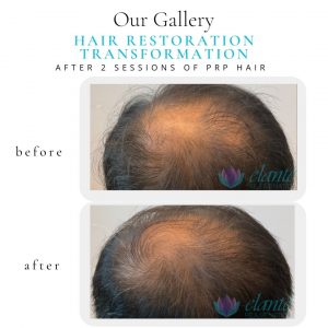 PRP Hair Before & After | Before & After | Elanté Rejuvenation | Medical Grade Aesthetics Clinic | SW Calgary