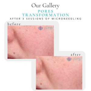 Microneedling Before & After | Before & After | Elanté Rejuvenation | Medical Grade Aesthetics Clinic | SW Calgary