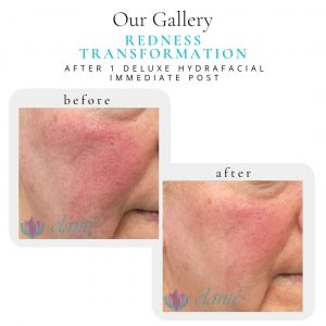 Deluxe HydraFacial Before & After | Before & After | Elanté Rejuvenation | Medical Grade Aesthetics Clinic | SW Calgary