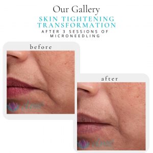 Microneedling Before & After | Before & After | Elanté Rejuvenation | Medical Grade Aesthetics Clinic | SW Calgary