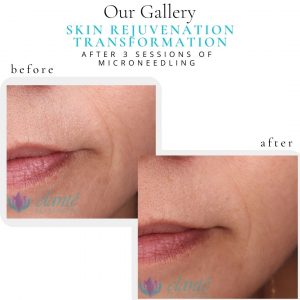 Microneedling Before & After | Before & After | Elanté Rejuvenation | Medical Grade Aesthetics Clinic | SW Calgary