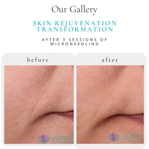 Microneedling Before & After | Before & After | Elanté Rejuvenation | Medical Grade Aesthetics Clinic | SW Calgary