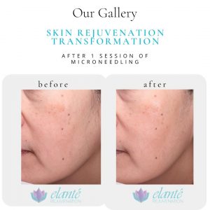 Microneedling Before & After | Before & After | Elanté Rejuvenation | Medical Grade Aesthetics Clinic | SW Calgary