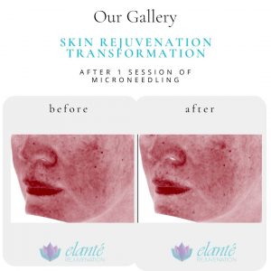 SkinPen Microneedling Before & After | Before & After | Elanté Rejuvenation | Medical Grade Aesthetics Clinic | SW Calgary